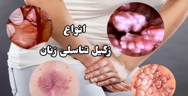 مطب درمان زگیل تناسلی زینب بهاروند در خرم آباد