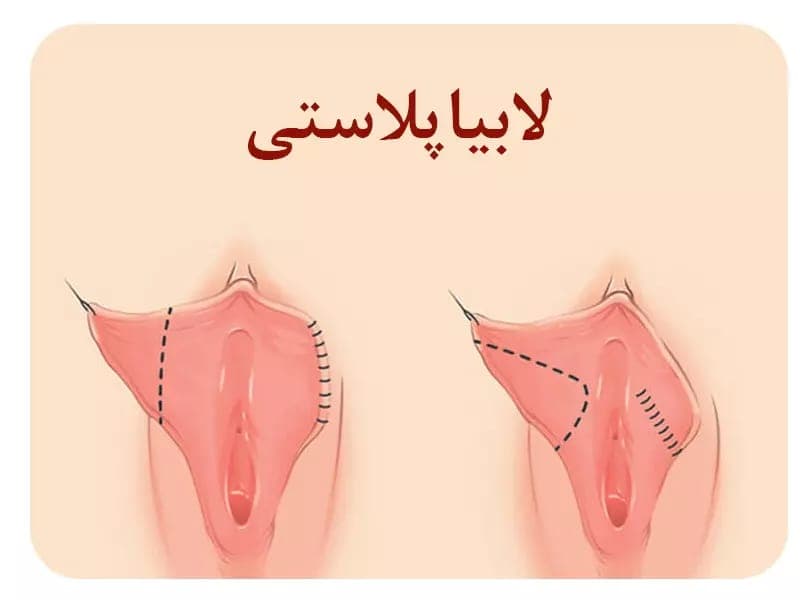مطب لابیا پلاستی زینب بهاروند در خرم آباد