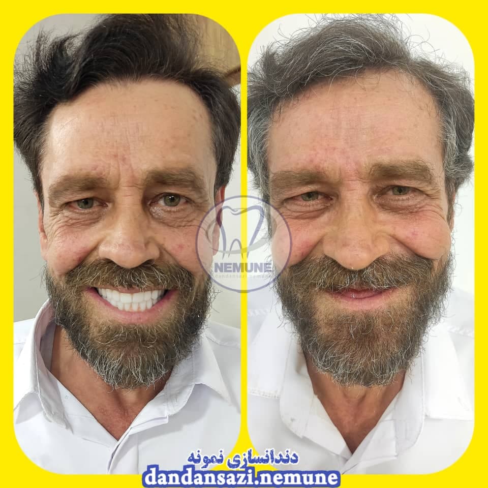 مطب ساخت پروتز دندان مصنوعی نمونه دکتر محمود حبیبی در ستارخان تهران