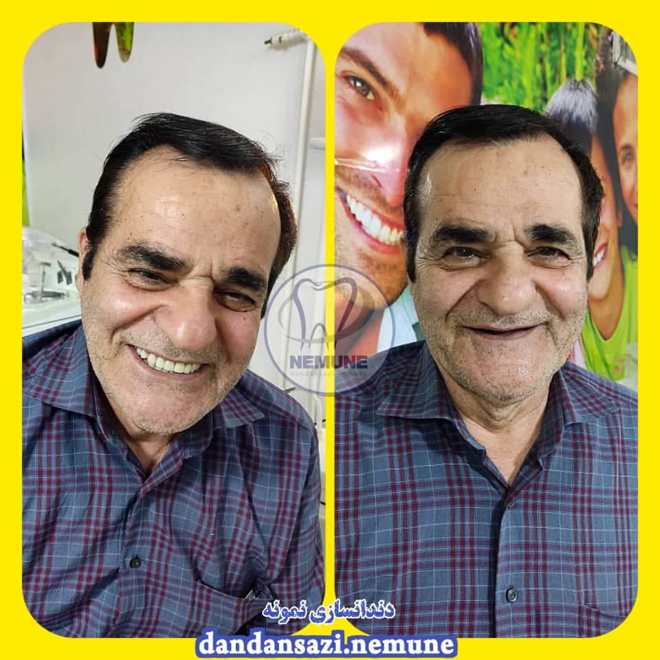 مطب ساخت پروتز دندان مصنوعی نمونه دکتر محمود حبیبی در ستارخان تهران
