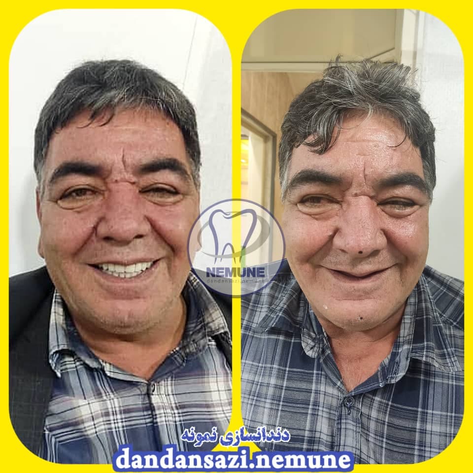 مطب ساخت پروتز دندان مصنوعی نمونه دکتر محمود حبیبی در ستارخان تهران