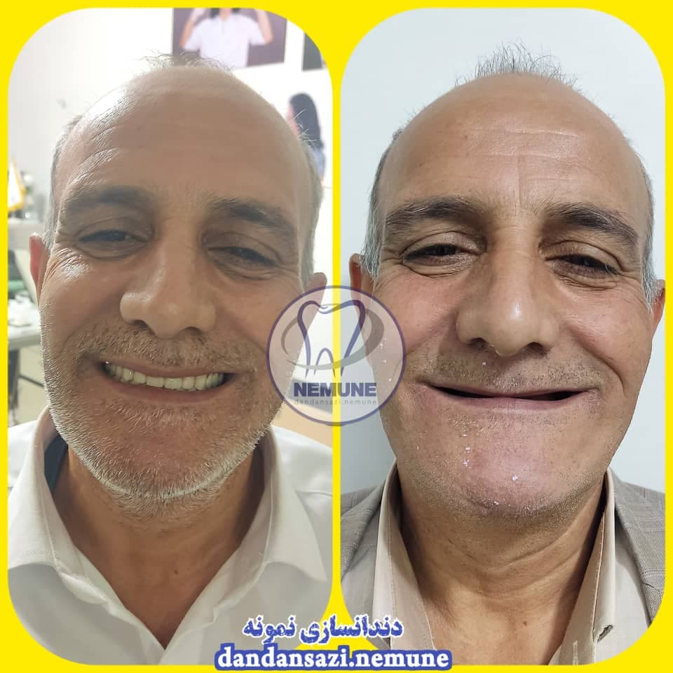 مطب ساخت پروتز دندان مصنوعی نمونه دکتر محمود حبیبی در ستارخان تهران
