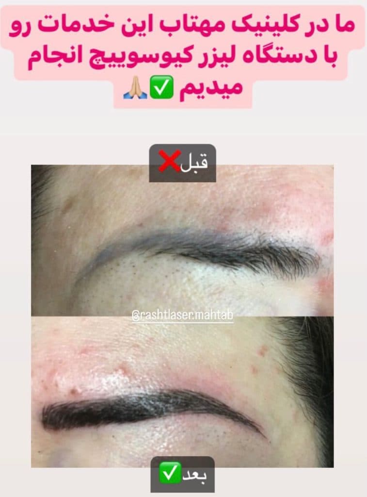 ریموو تاتو مهتاب در تهران