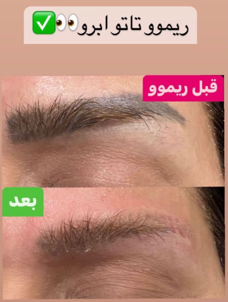 ریموو تاتو مهتاب در تهران
