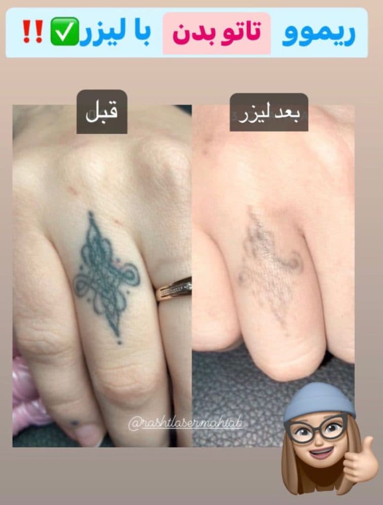 ریموو تاتو مهتاب در تهران