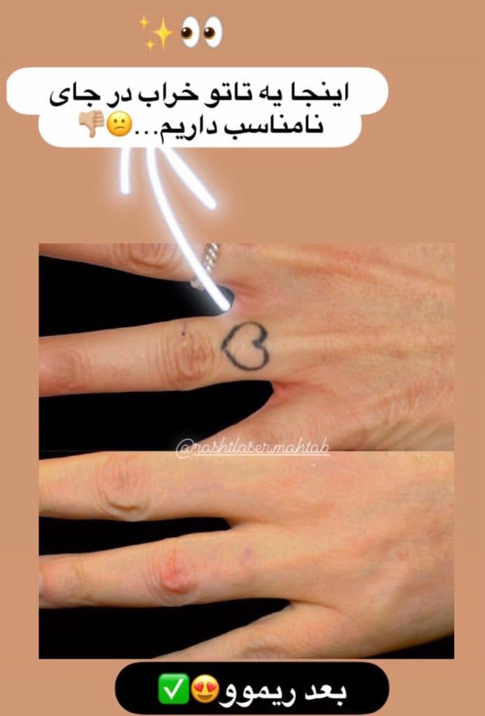 ریموو تاتو مهتاب در تهران