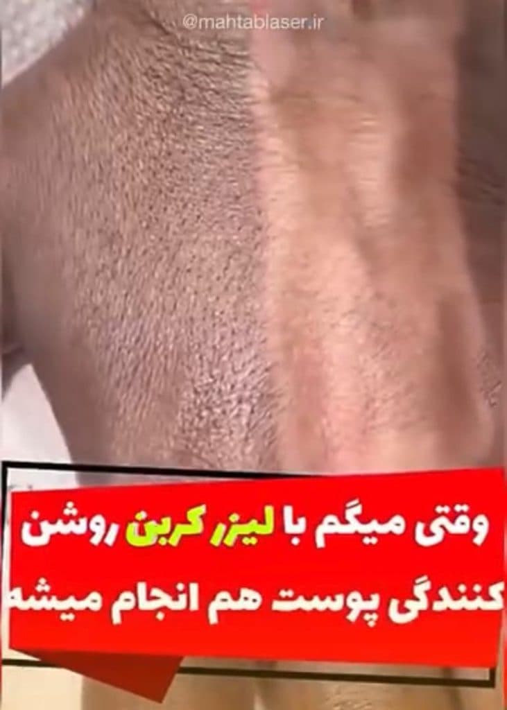 کربن تراپی مهتاب در تهران