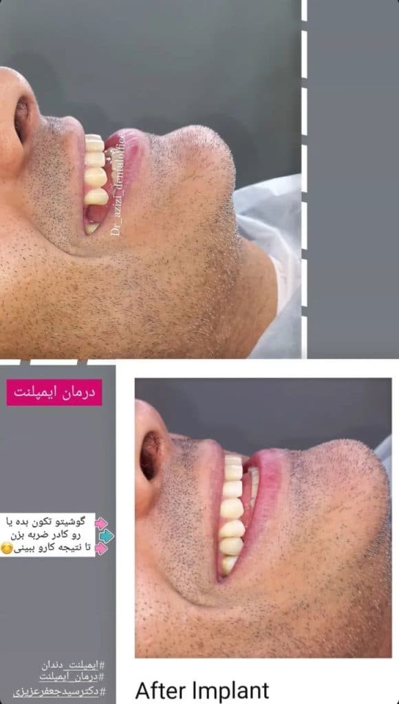 ایمپلنت دیجیتال و فوری دکتر سید جعفر عزیزی در رشت