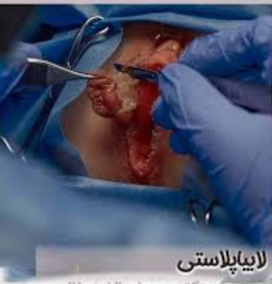 مرکز تخصصی لابیاپلاستی با لیزر غنچه در خرم آباد
