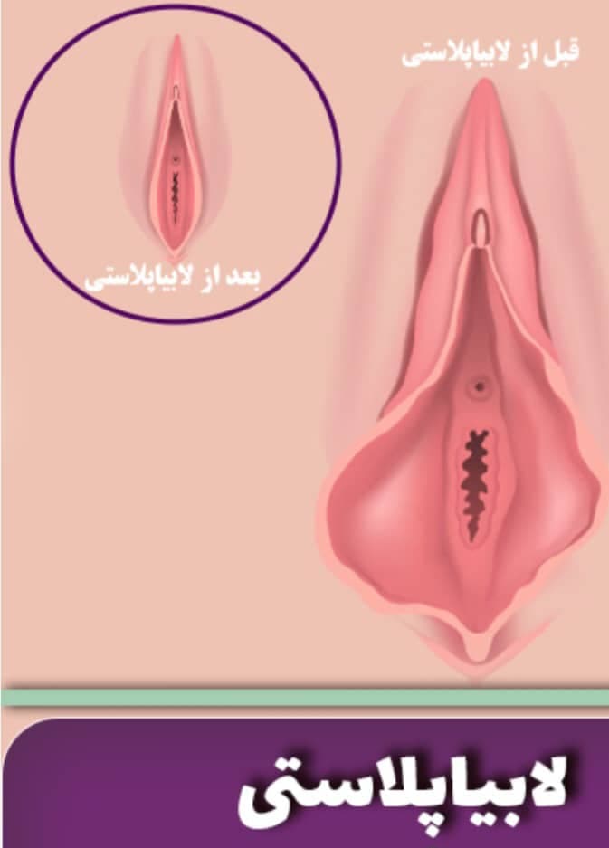 مرکز تخصصی لابیاپلاستی با لیزر غنچه در خرم آباد