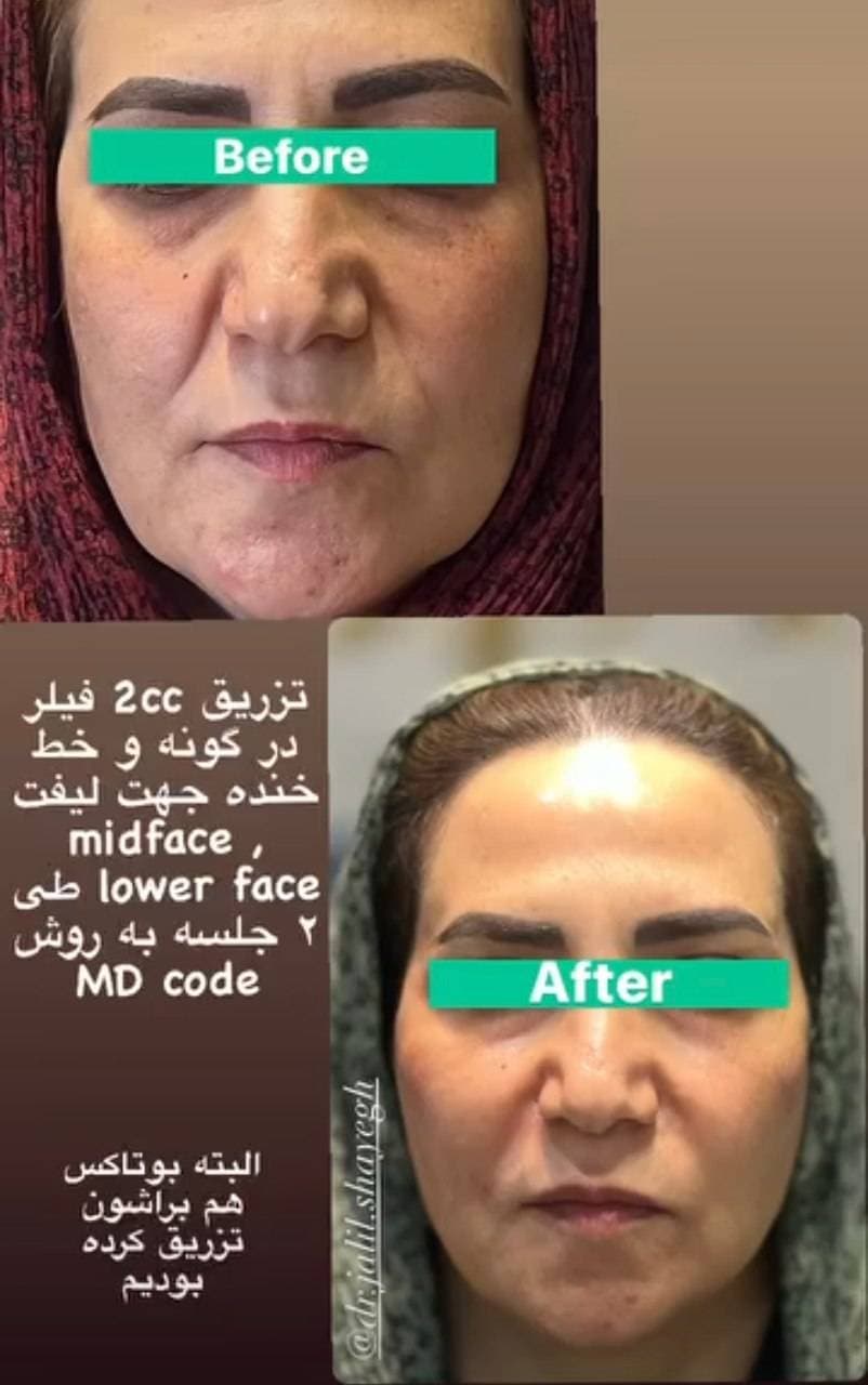 کلینیک تخصصی تزریق فیلر و بوتاکس دکتر جلیل شایق در یزد