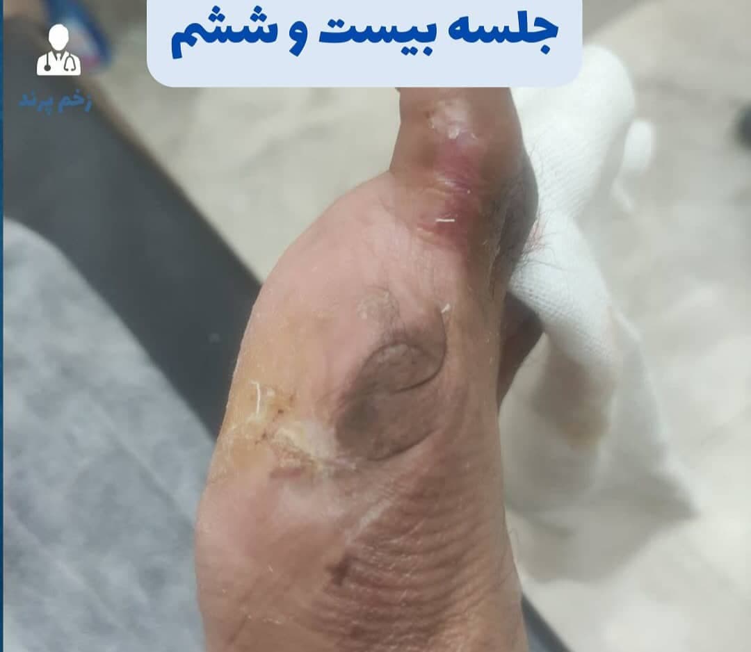 کلینیک درمان سوختگی و زخم پا در پرند با مدیریت طاها قادری