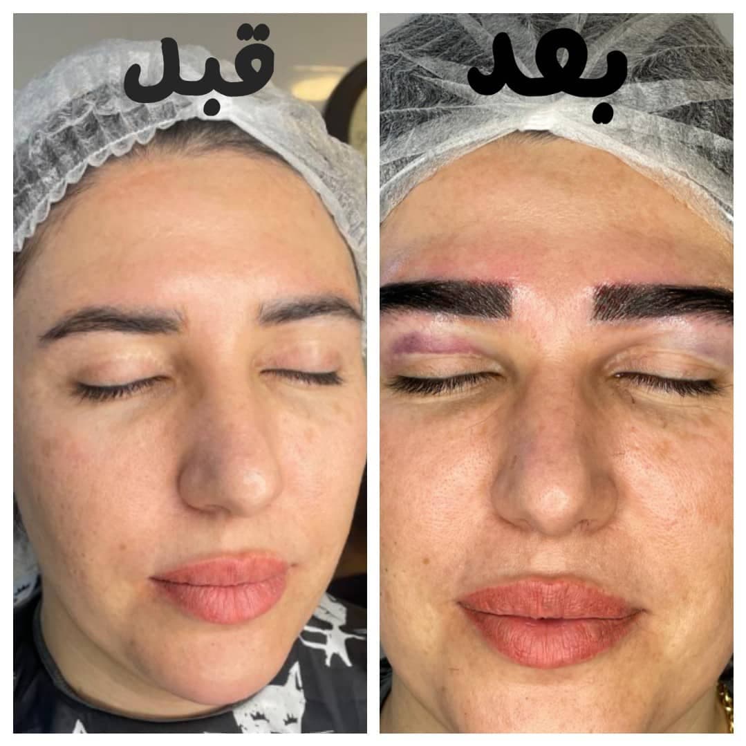 خدمات تخصصی کاشت مو و ابرو زیرنظر تکنسین زینب شیری در شیراز