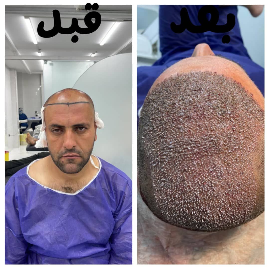 خدمات تخصصی کاشت مو و ابرو زیرنظر تکنسین زینب شیری در شیراز