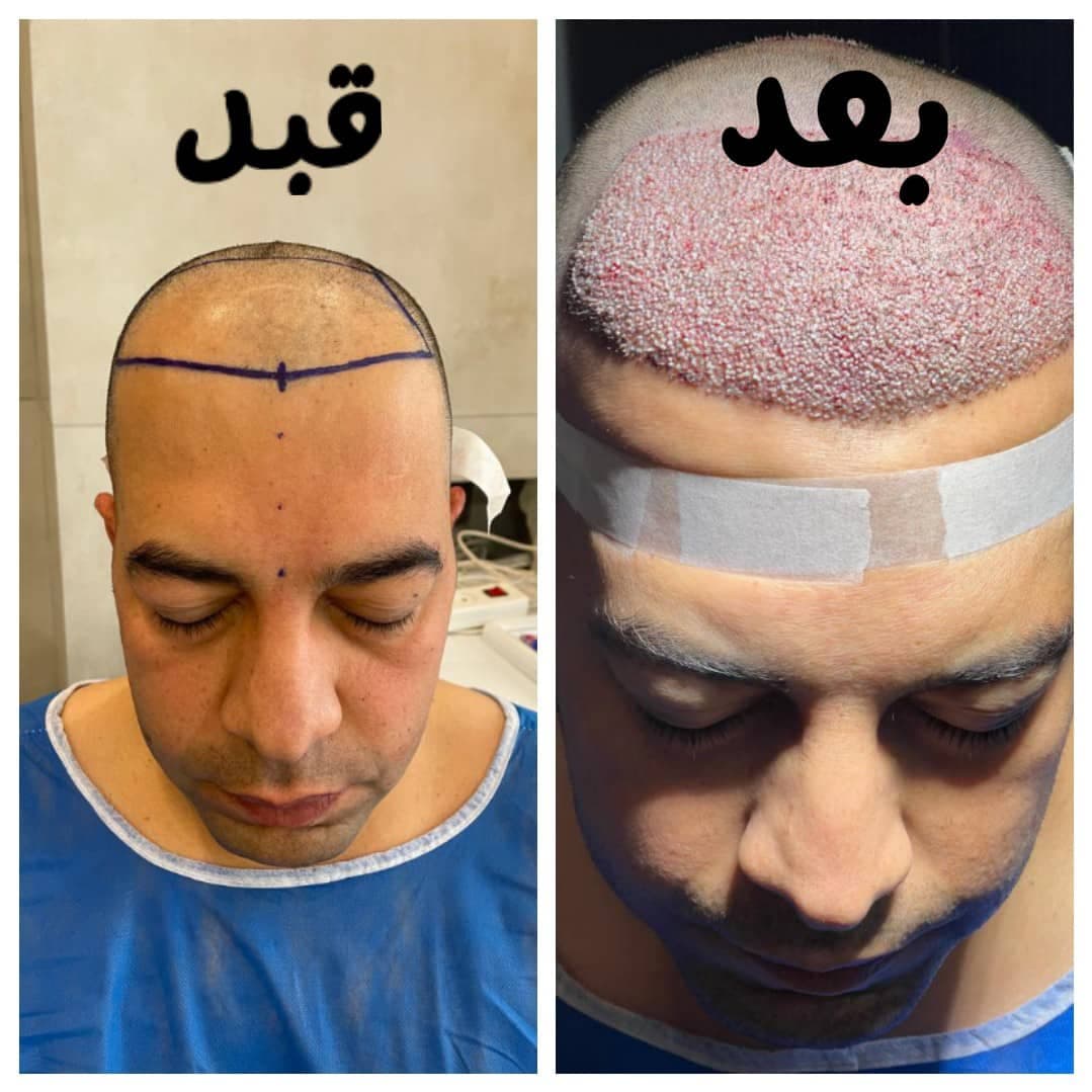 خدمات تخصصی کاشت مو و ابرو زیرنظر تکنسین زینب شیری در شیراز