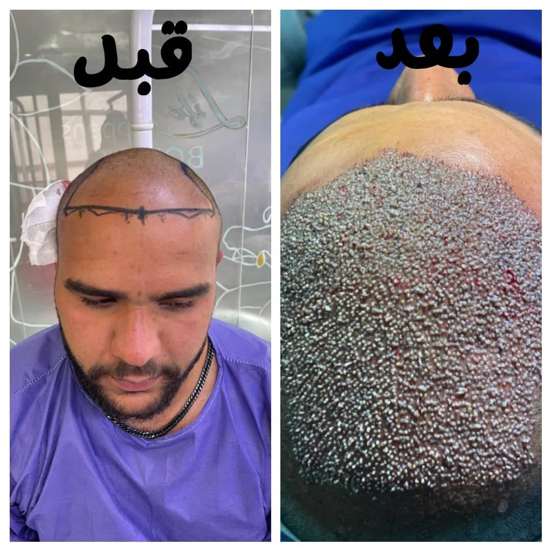 خدمات تخصصی کاشت مو و ابرو زیرنظر تکنسین زینب شیری در شیراز