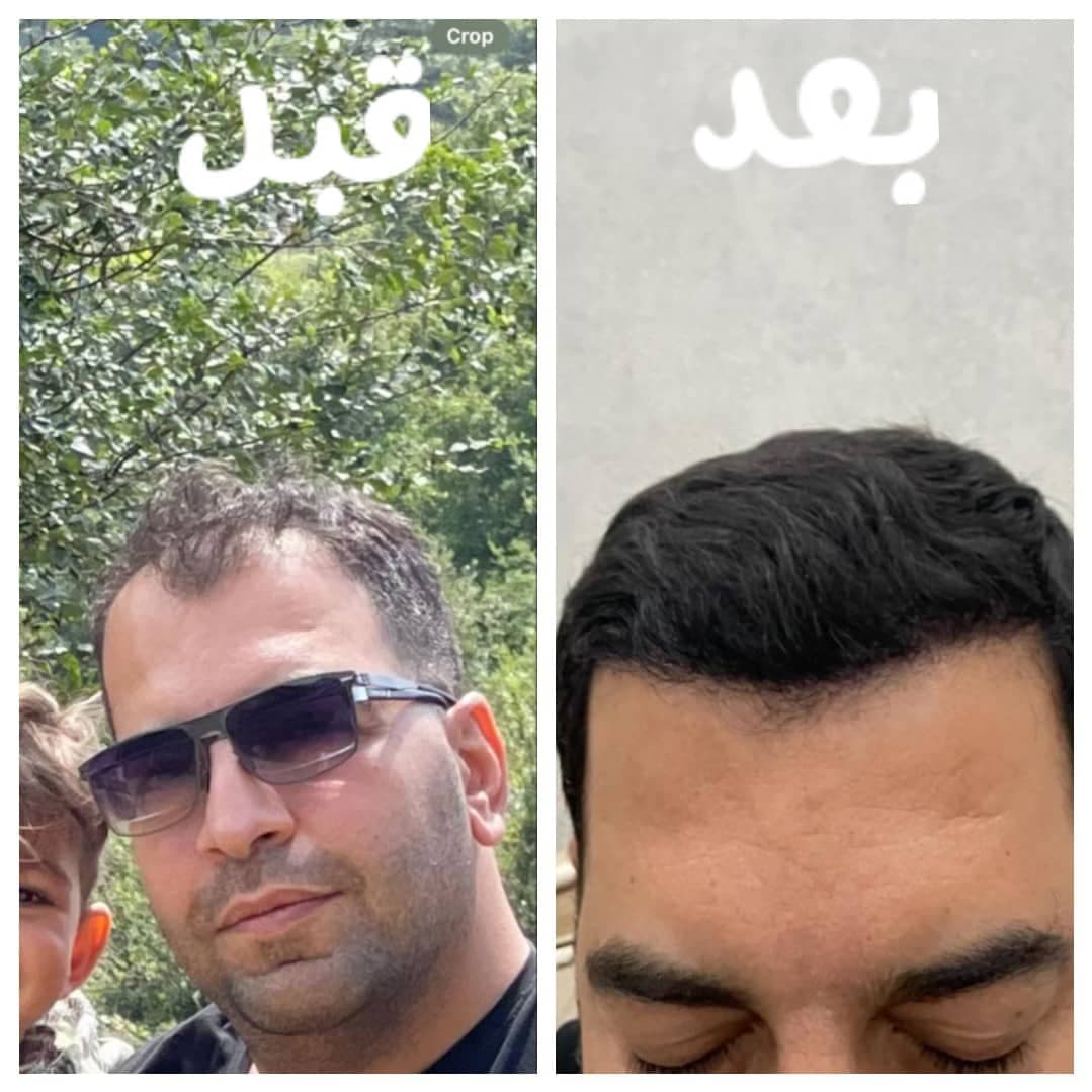 خدمات تخصصی کاشت مو و ابرو زیرنظر تکنسین زینب شیری در شیراز