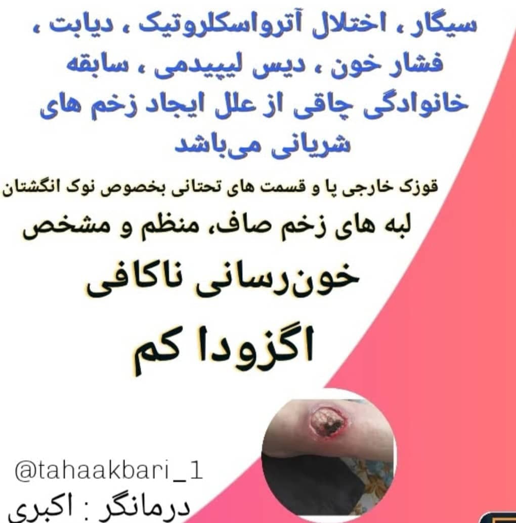 درمان زخم دیابتی و بستر درمانگر زخم طاها اکبری در تبریز