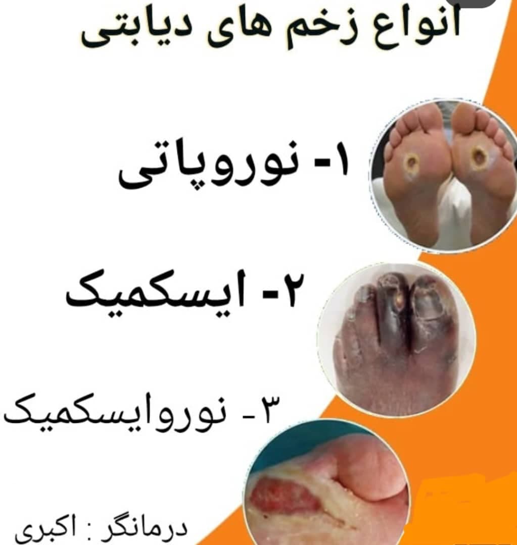درمان زخم دیابتی و بستر درمانگر زخم طاها اکبری در تبریز