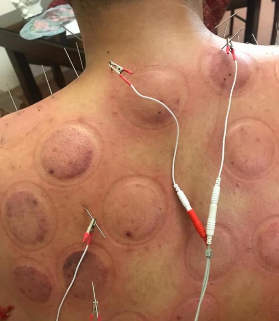 طب سوزنی باران در شیراز