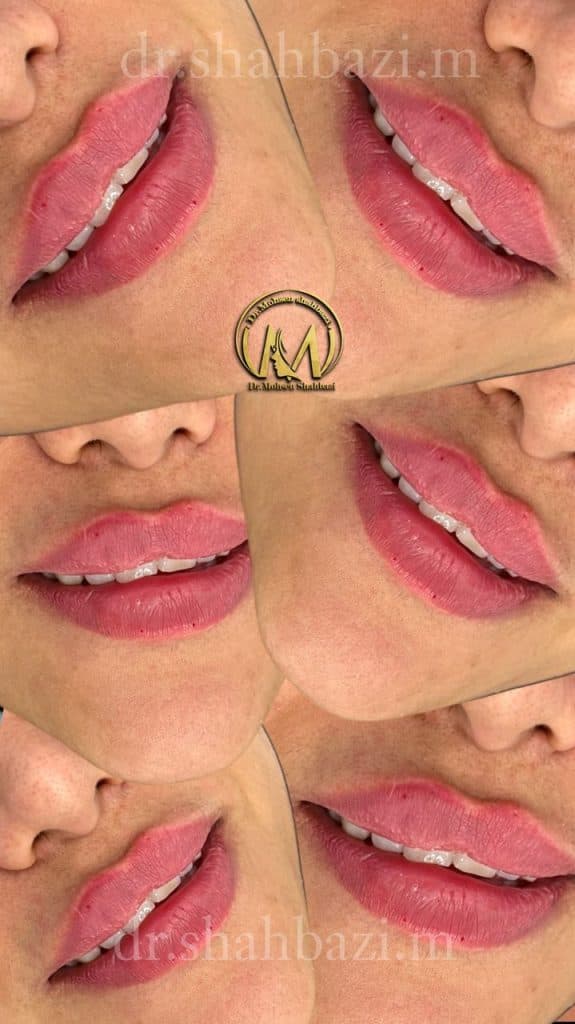 مرکز بوتاکس و تزریق ژل دکتر شهبازی در یزد