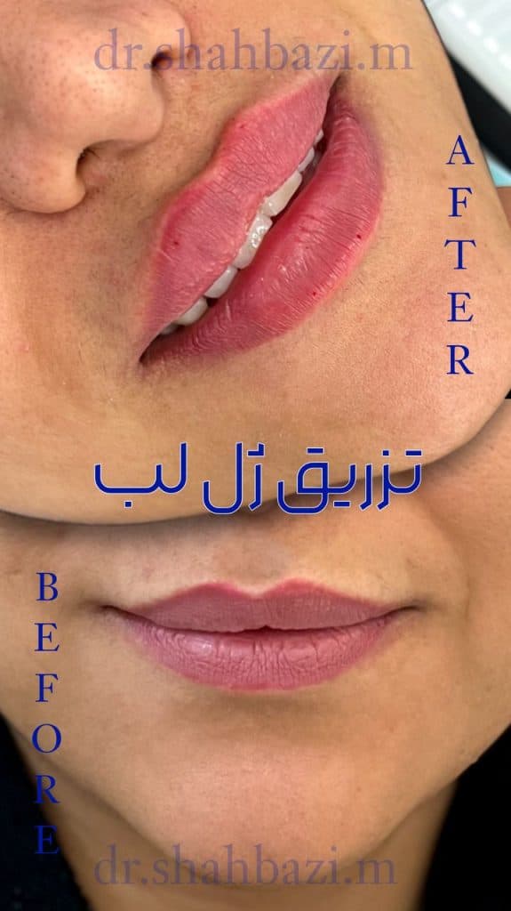 مرکز بوتاکس و تزریق ژل دکتر شهبازی در یزد