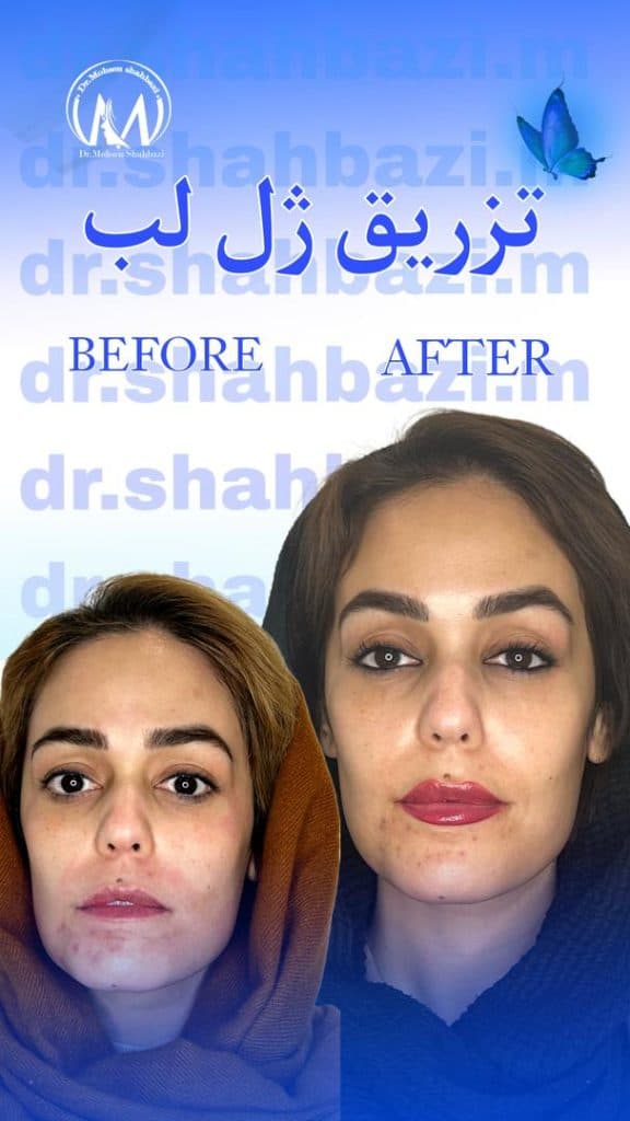 مرکز بوتاکس و تزریق ژل دکتر شهبازی در یزد