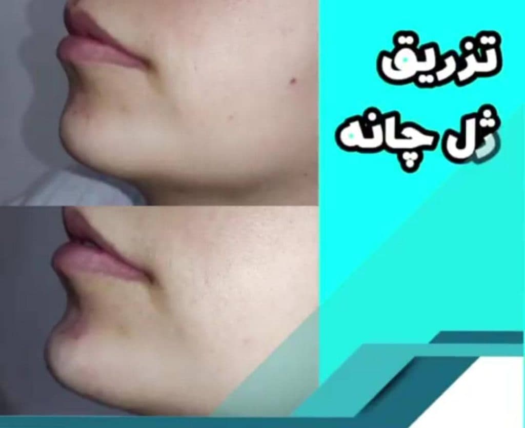 تزریق ژل و بوتاکس فرهادی در لرستان