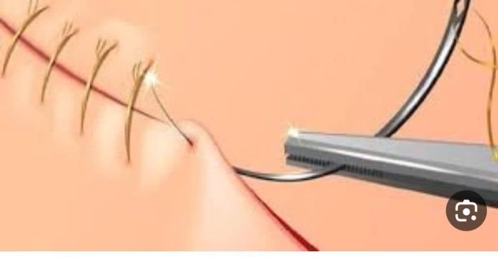 خدمات درمان زگیل تناسلی و ترمیم و لیزر و هایفو درسا در خرم آباد