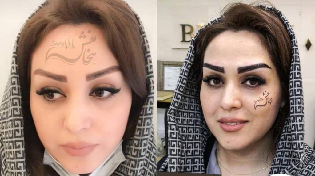 کاشت مو و ابرو هخامنش در شیراز