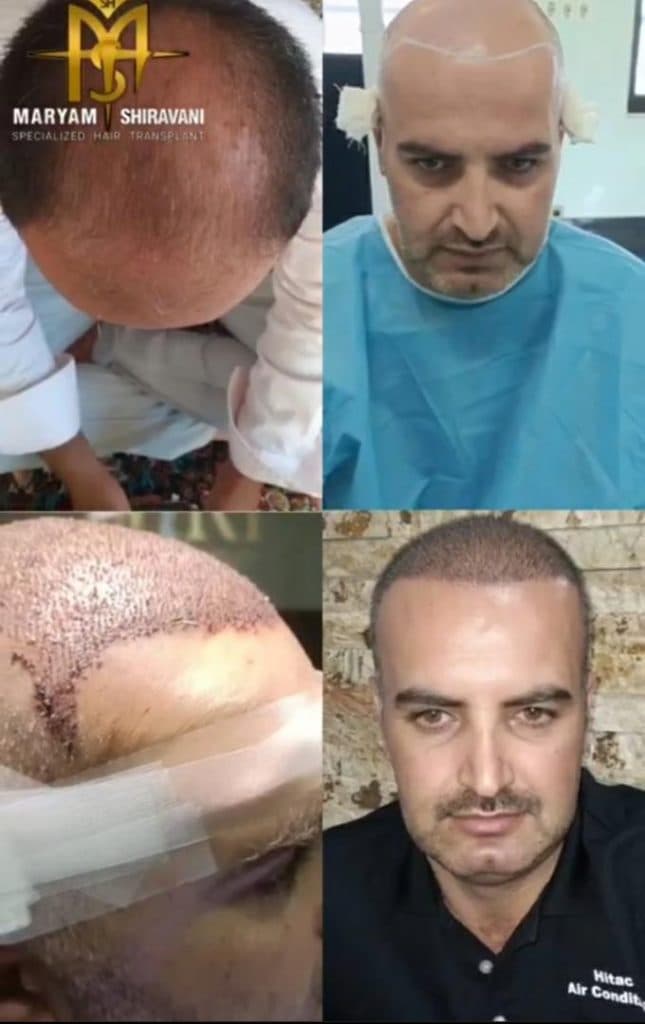 کاشت مو و ابرو مریم شیروانی در شیراز