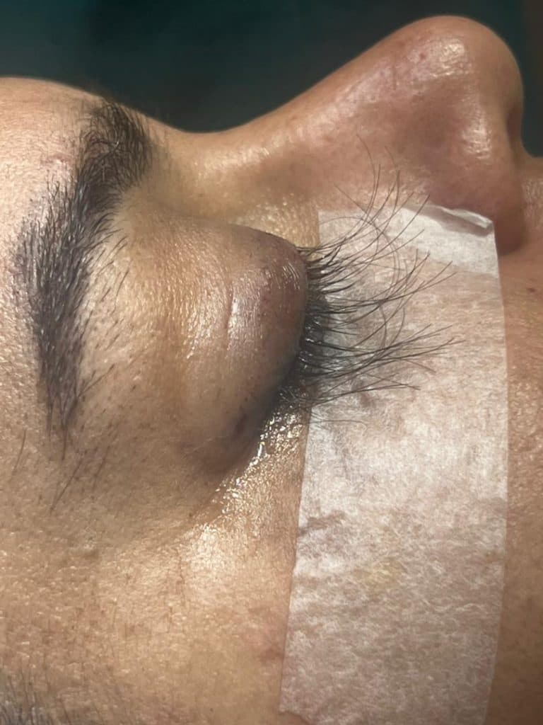 کاشت مو و ابرو هخامنش در شیراز