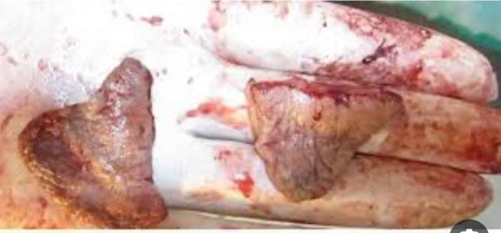 خدمات درمان زگیل تناسلی و ترمیم و لیزر و هایفو درسا در خرم آباد