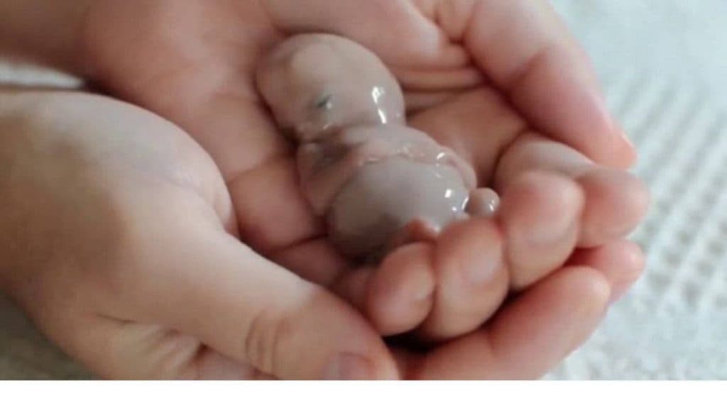 خدمات درمان زگیل تناسلی و ترمیم و لیزر و هایفو درسا در خرم آباد