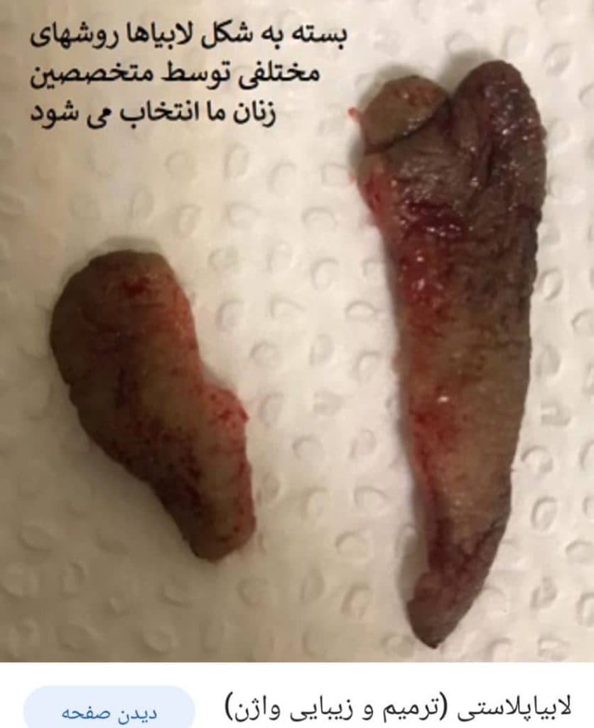 خدمات درمان زگیل تناسلی و ترمیم و لیزر و هایفو درسا در خرم آباد