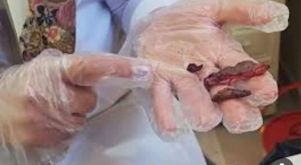 خدمات درمان زگیل تناسلی و ترمیم و لیزر و هایفو درسا در خرم آباد