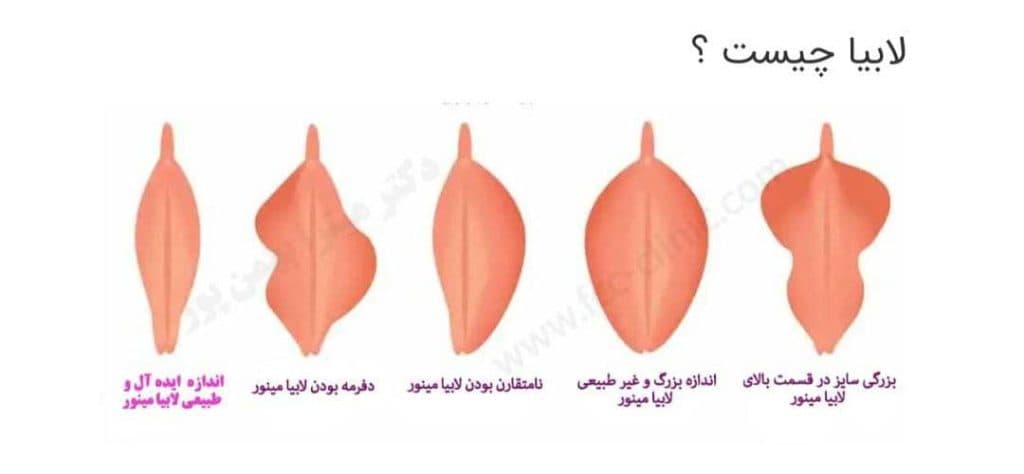 خدمات درمان زگیل تناسلی و ترمیم و لیزر و هایفو درسا در خرم آباد