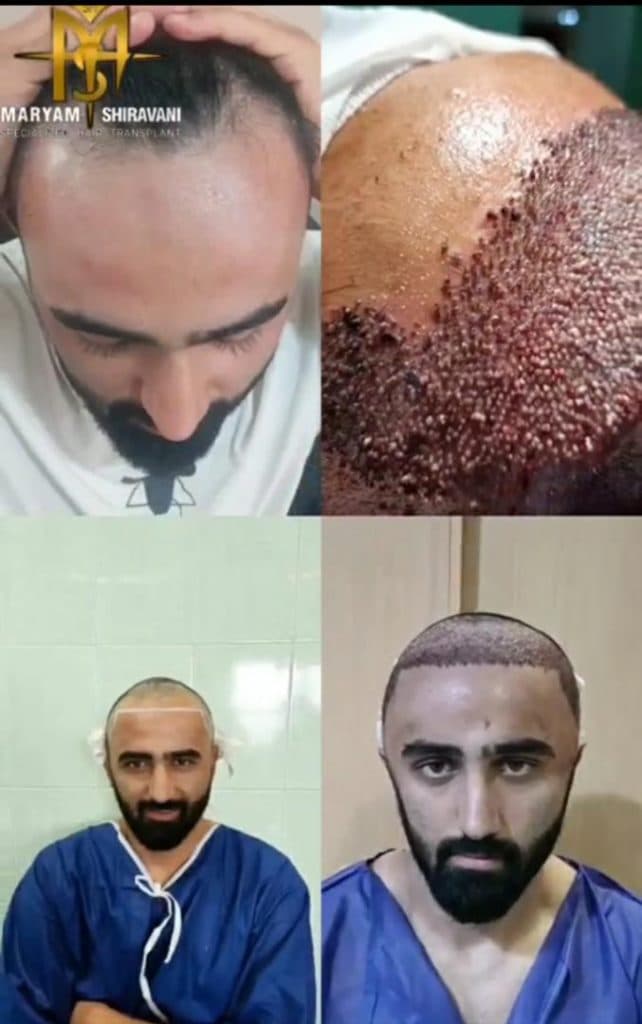 کاشت مو و ابرو مریم شیروانی در شیراز