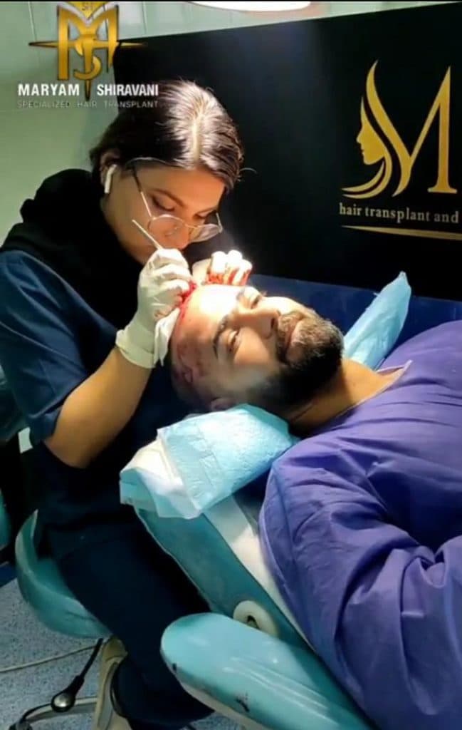 کاشت مو و ابرو مریم شیروانی در شیراز