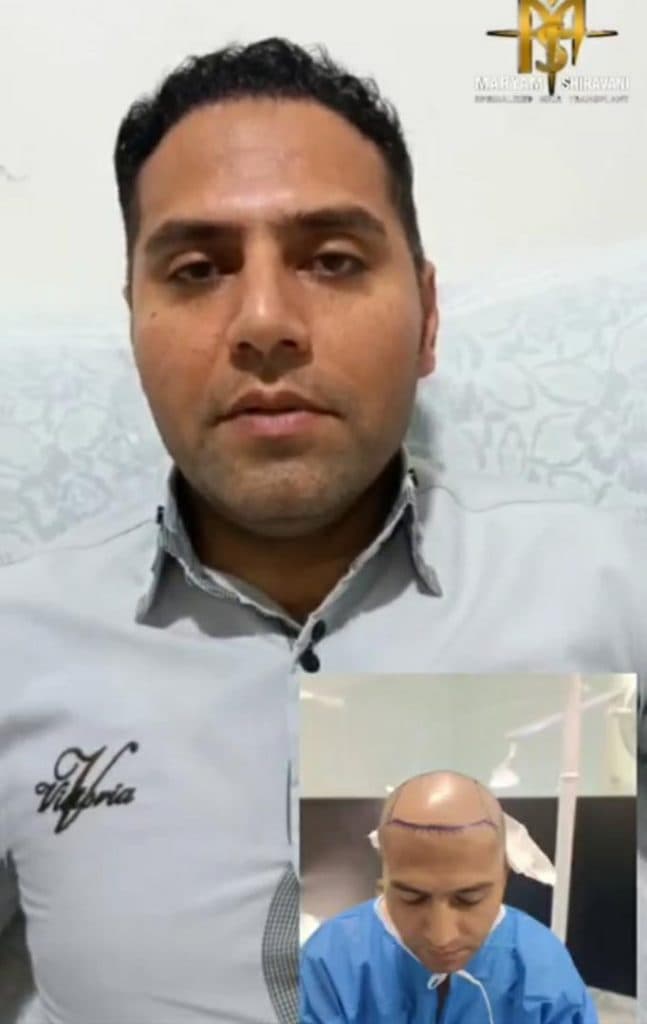 کاشت مو و ابرو مریم شیروانی در شیراز