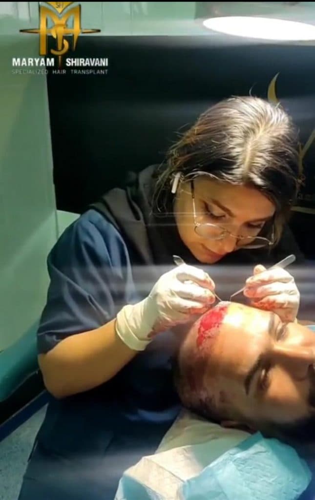 کاشت مو و ابرو مریم شیروانی در شیراز