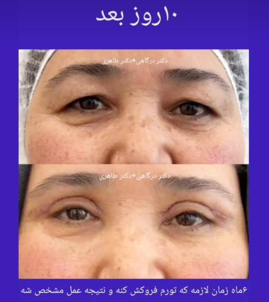 عمل جراحی پلک بلفاروپلاستی دکتر مینا درگاهی و مصطفی طاهری در تهران