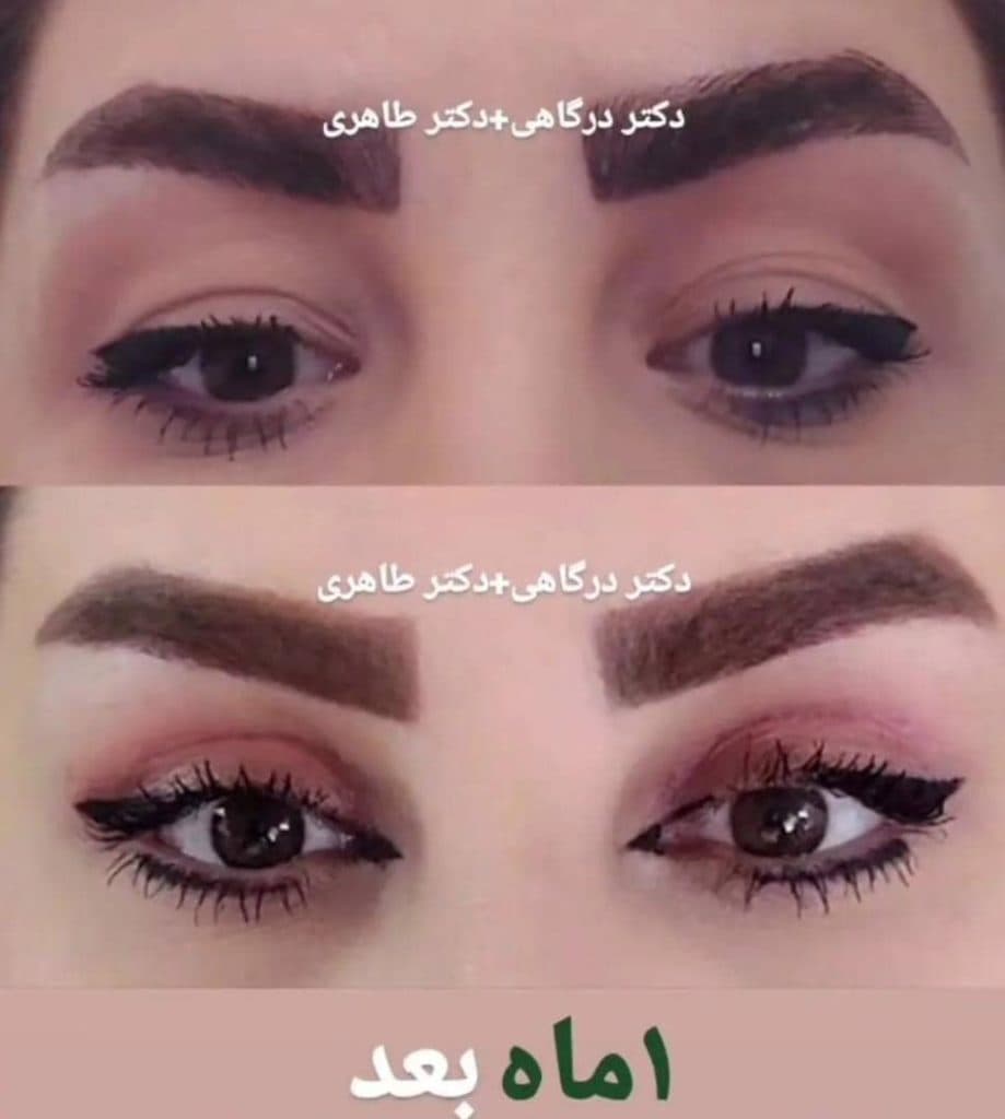 عمل جراحی پلک بلفاروپلاستی دکتر مینا درگاهی و مصطفی طاهری در تهران