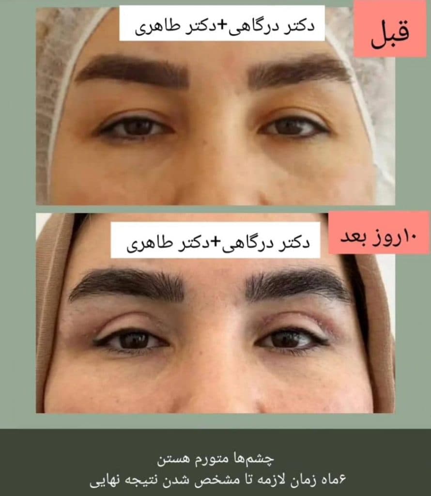 عمل جراحی پلک بلفاروپلاستی دکتر مینا درگاهی و مصطفی طاهری در تهران