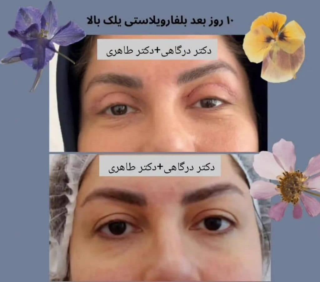 عمل جراحی پلک بلفاروپلاستی دکتر مینا درگاهی و مصطفی طاهری در تهران