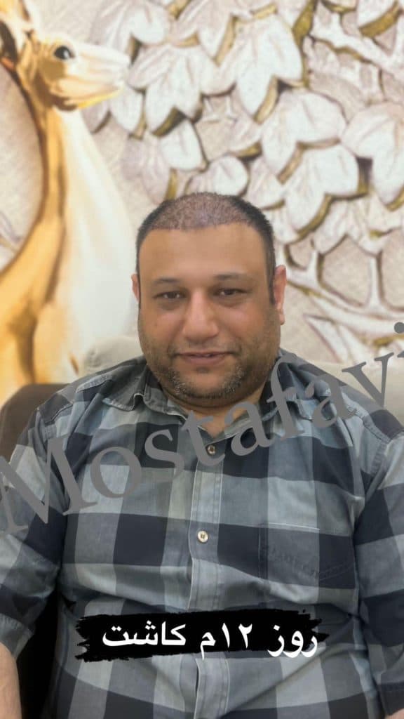 کلینیک تخصصی کاشت مو رویش در تبریز