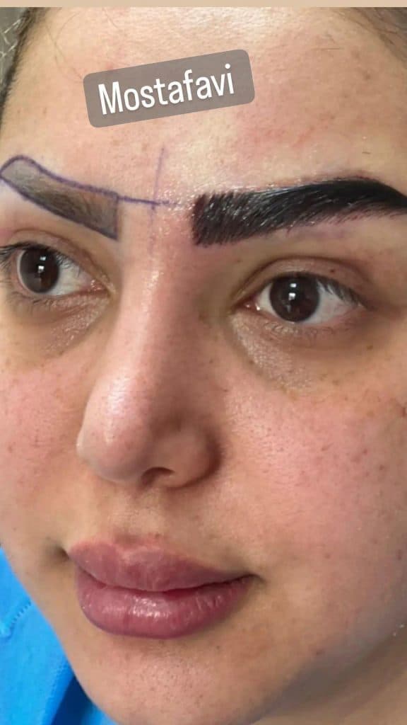 کلینیک تخصصی کاشت مو رویش در تبریز