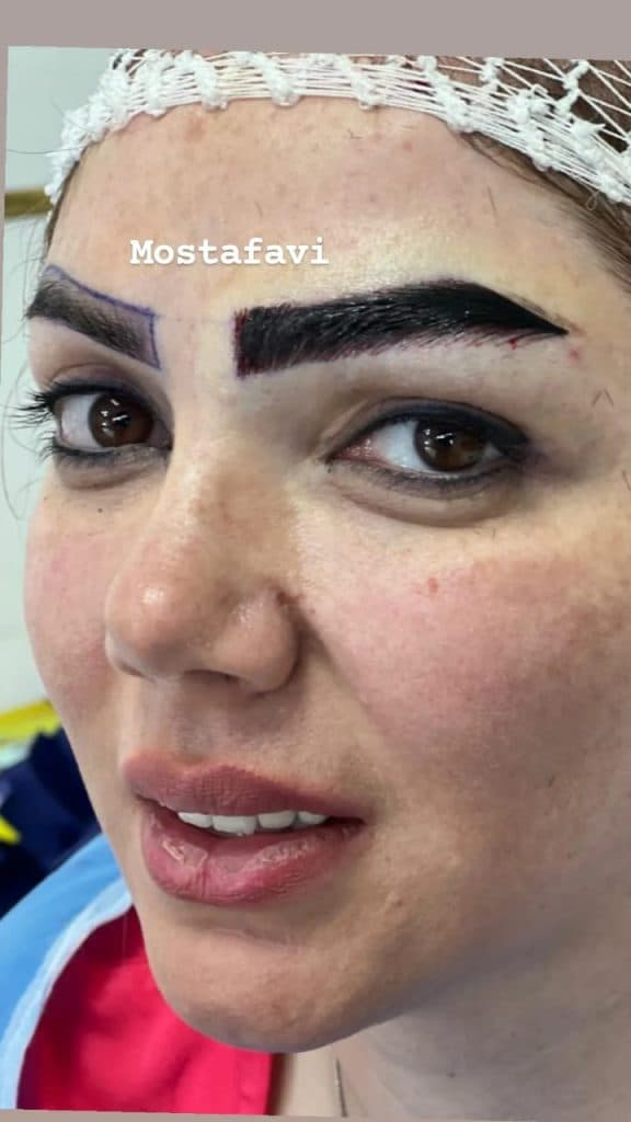 کلینیک تخصصی کاشت مو رویش در تبریز