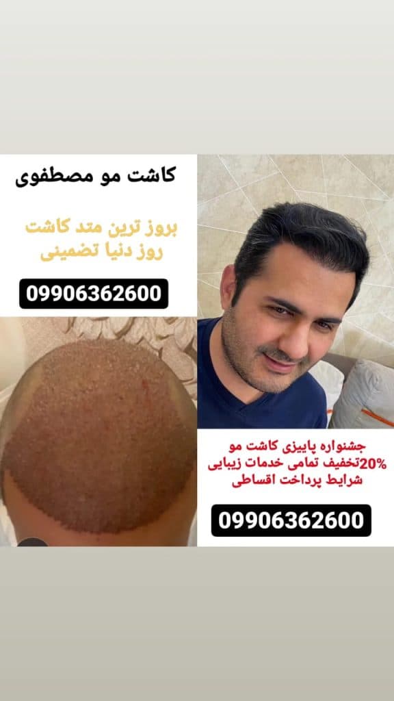 کلینیک تخصصی کاشت مو رویش در تبریز