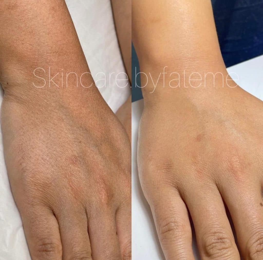 آموزش و خدمات تخصصی فیشیال با دستگاه پولاژن فرح اسدالله پور در رفسنجان